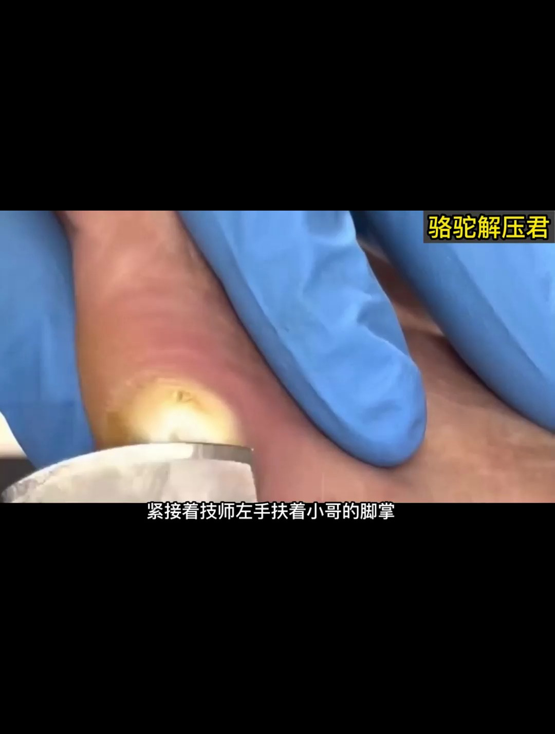 快看!大哥脚上长了很大一个脚鸡眼,修脚师傅教你如何处理鸡眼!