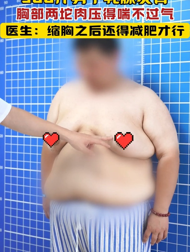 300斤男子乳腺发育,胸部两坨肉