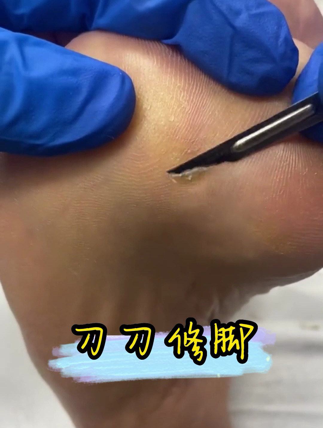 专业修脚,去除脚底鸡眼老茧死皮,超解压
