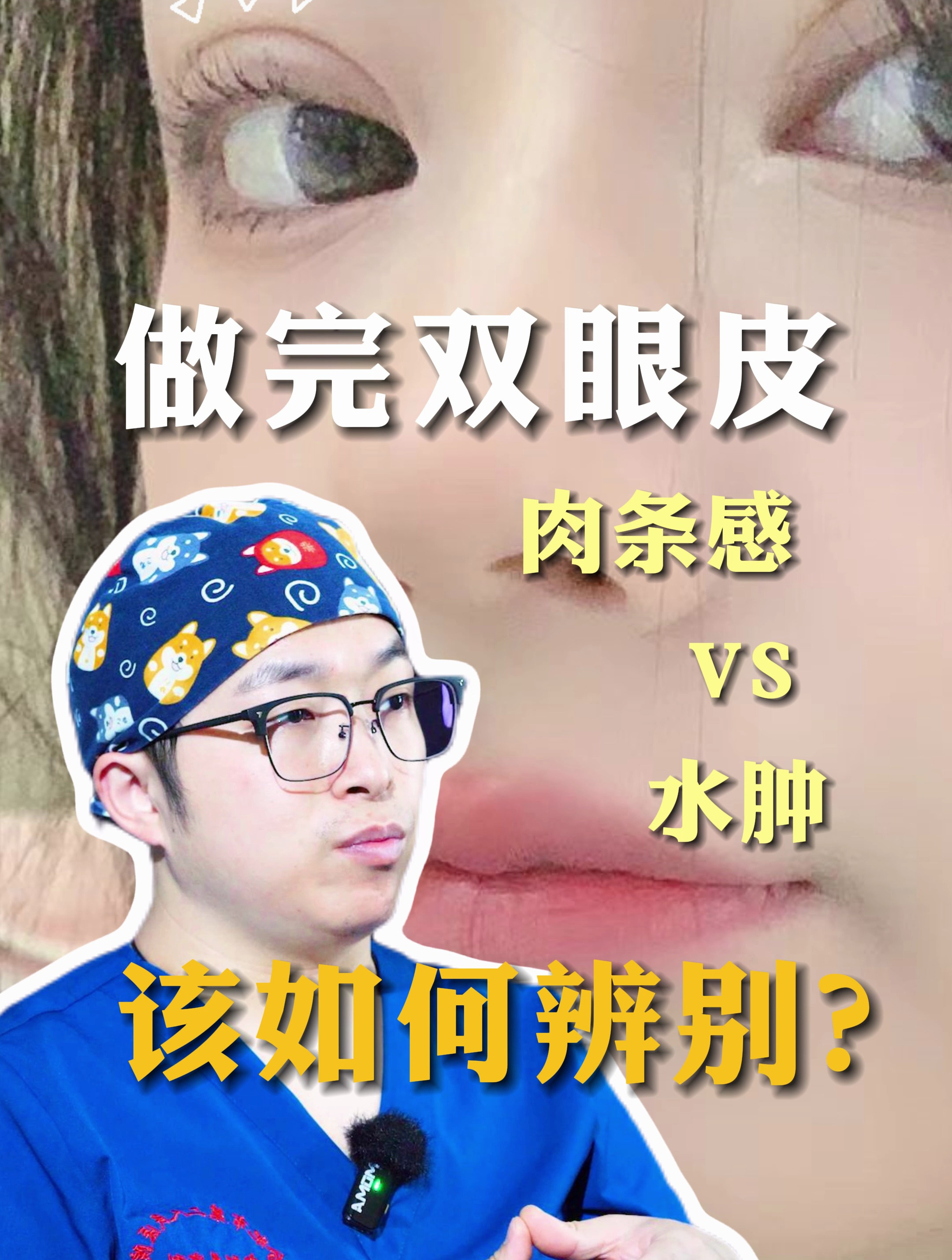 做完双眼皮,如何辨别肉条感还是水肿的问题呢?