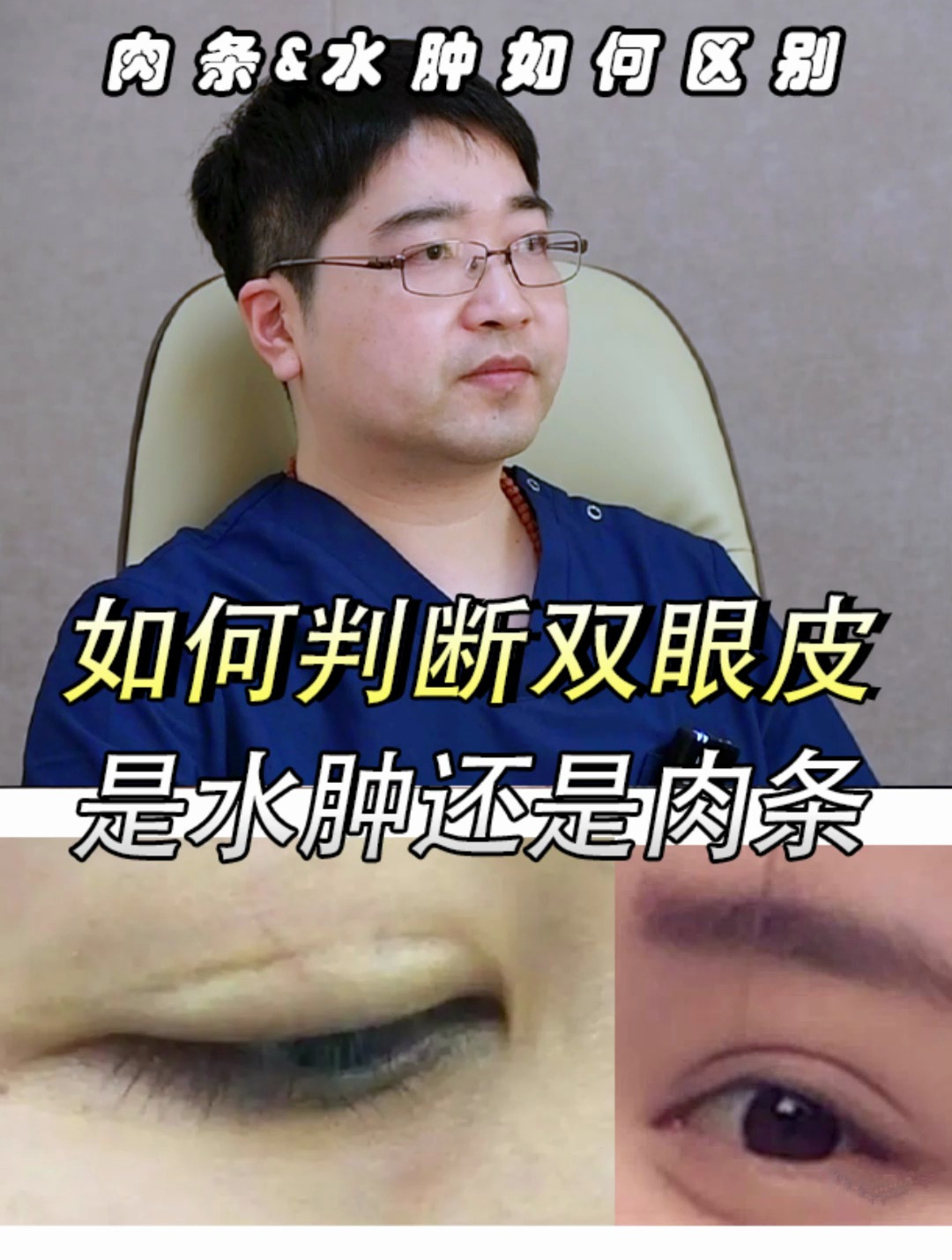 如何判断双眼皮是水肿还是肉条