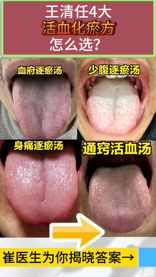 血瘀的4大舌象,活血化瘀你选对了吗?