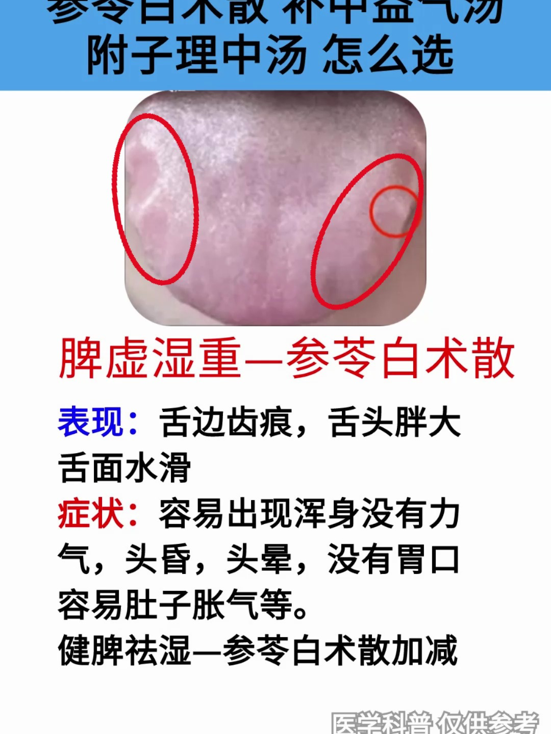 脾胃不好湿气重、参苓白术散、补中益气汤、附子理中汤怎么选