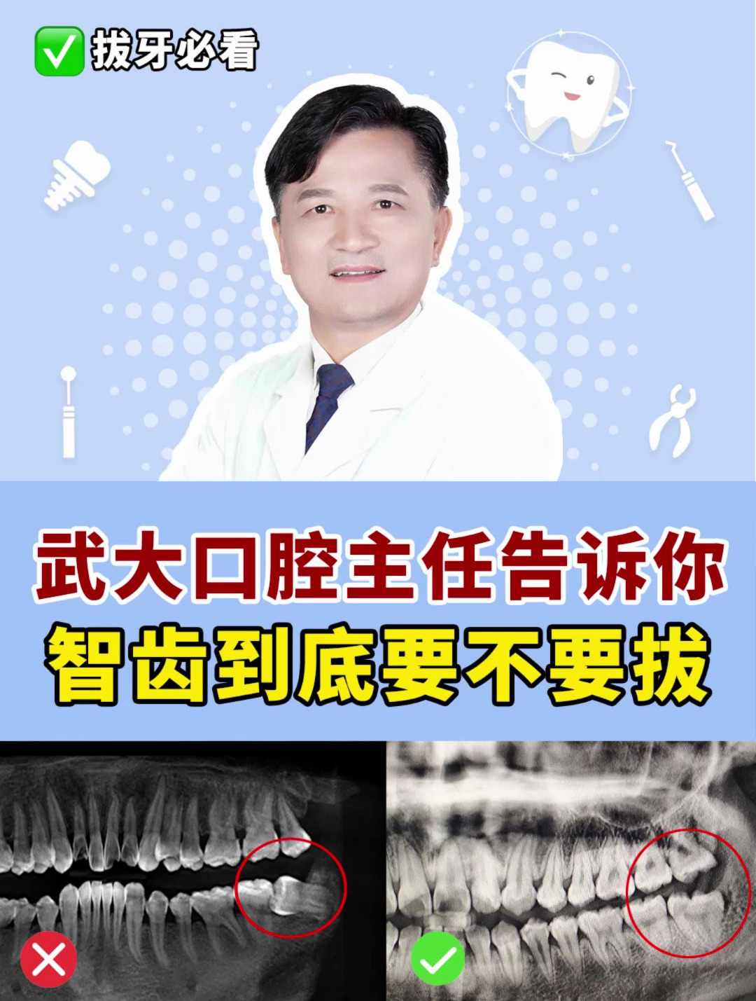 牙医专业解读:智齿究竟要不要拔掉?