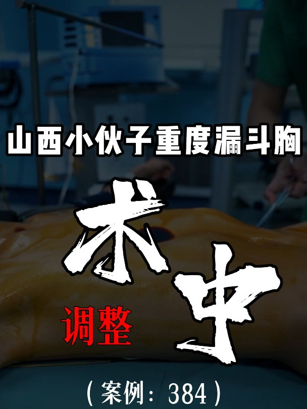 漏斗胸鸡胸医生张东升