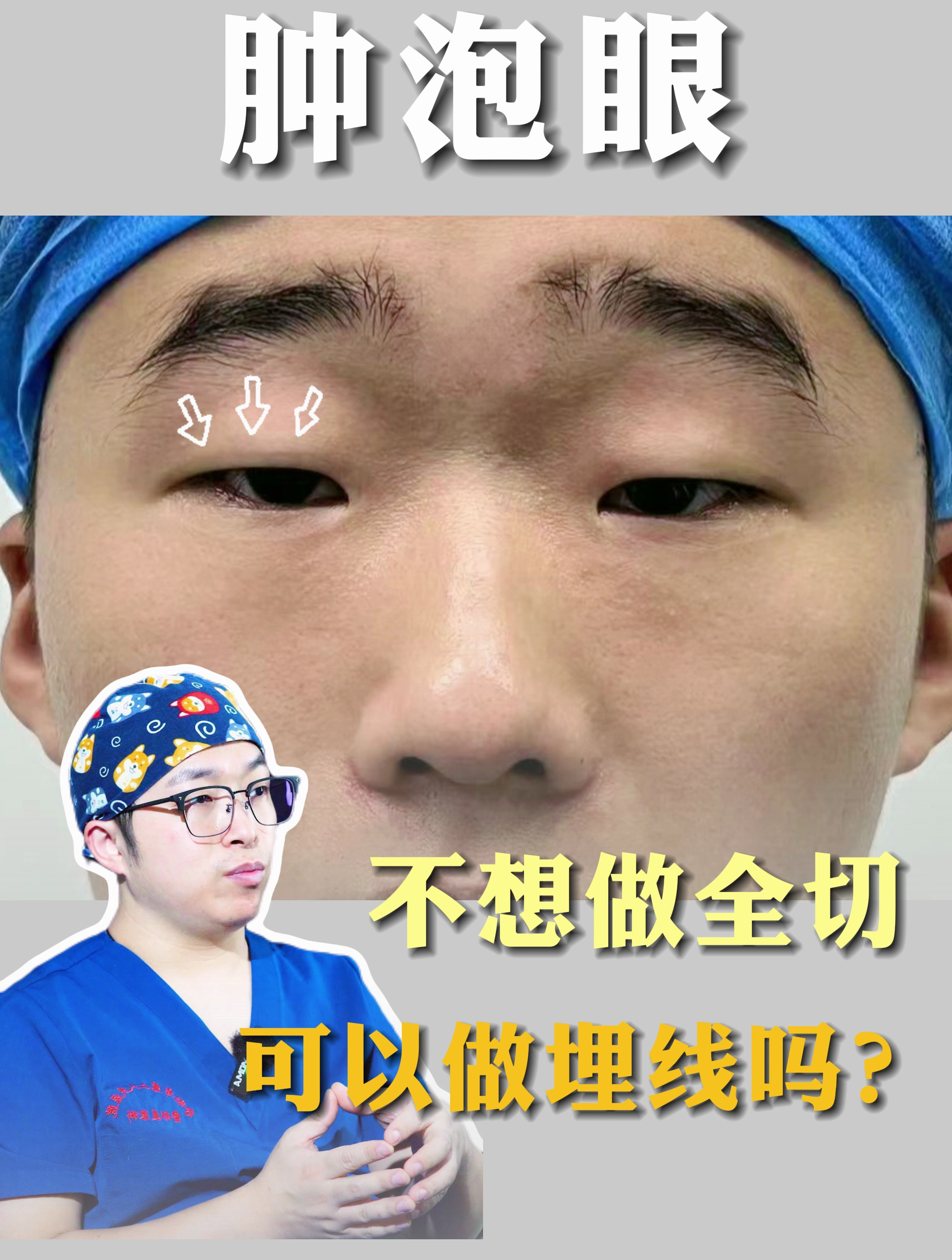 肿泡眼不想做全切,可以做埋线吗?