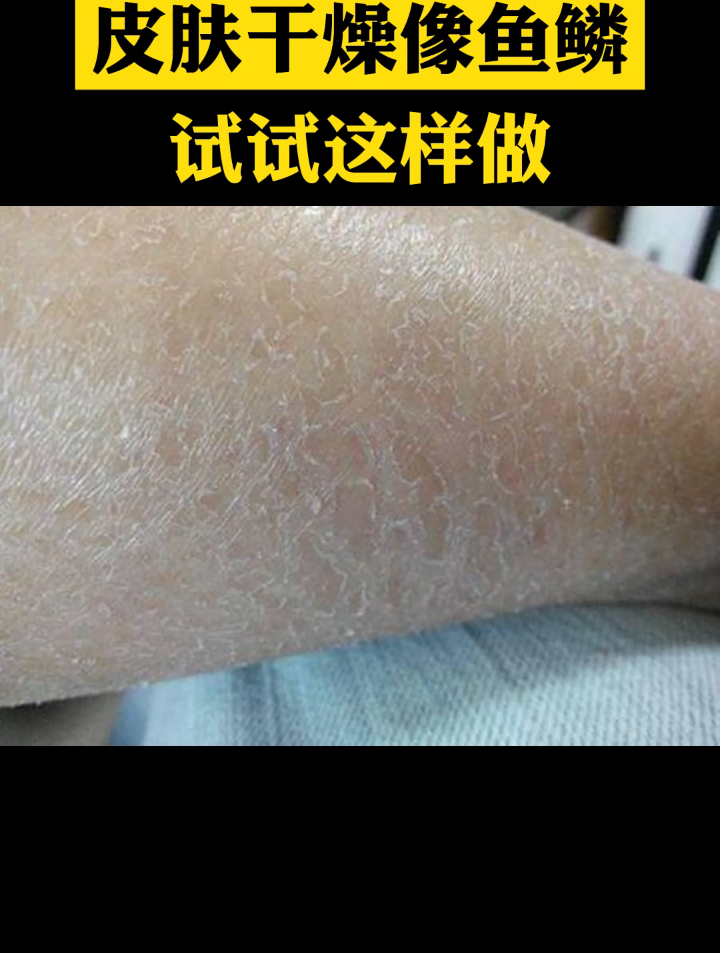 皮肤干燥像鱼鳞 试试这样做