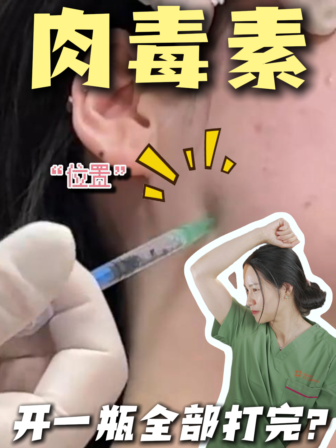 一瓶肉毒素都是怎么打的?