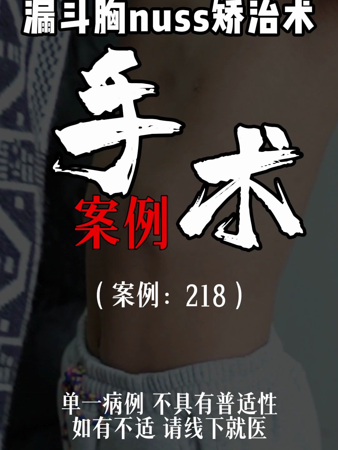 漏斗胸鸡胸医生张东升