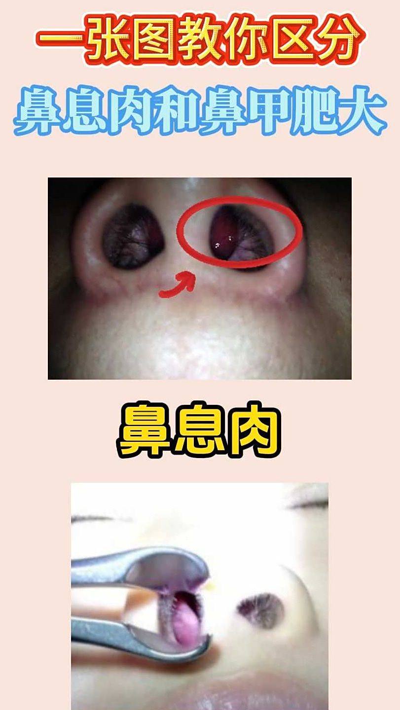 一张图教你分清鼻息肉和鼻甲肥大