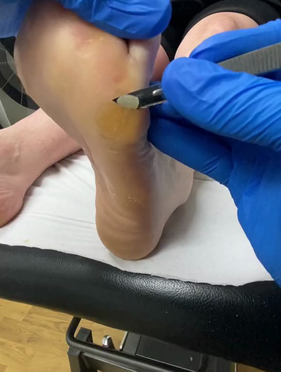 专业修脚,去除脚底鸡眼老茧死皮,超解压