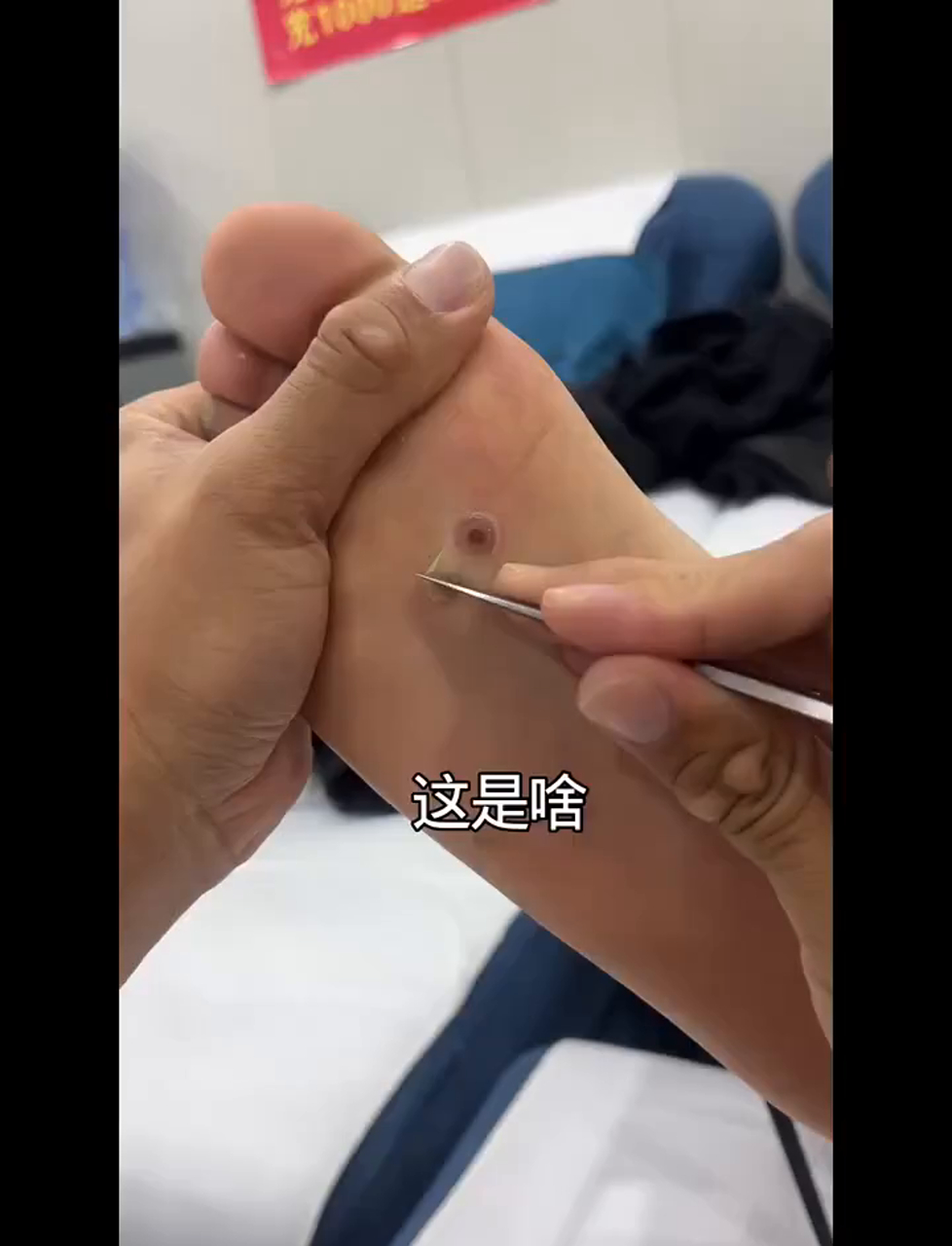 脚上长硬块别慌，可能是鸡眼或老茧，都是磨出来的别自己瞎剪