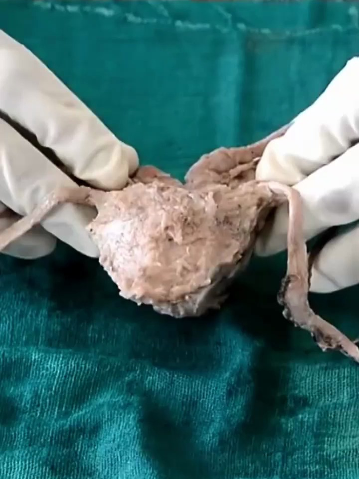 你知道人体的膀胱是什么样子吗?