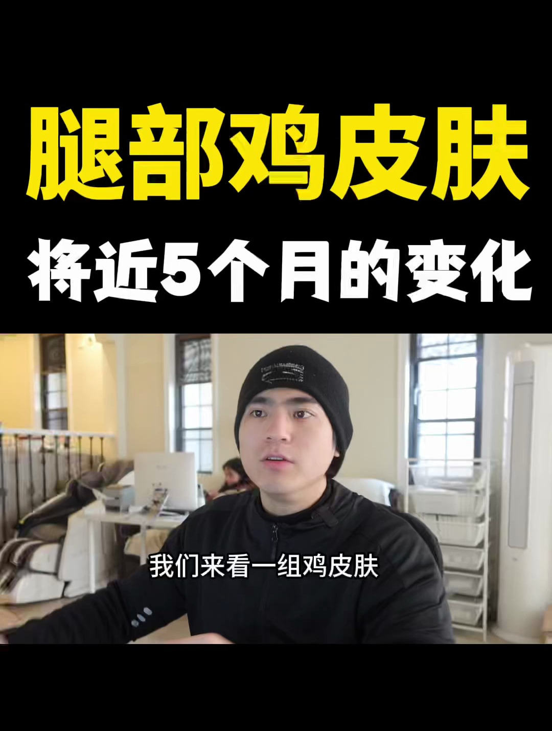 大小腿的闭合型鸡皮肤,整体是属于偏严重的一类