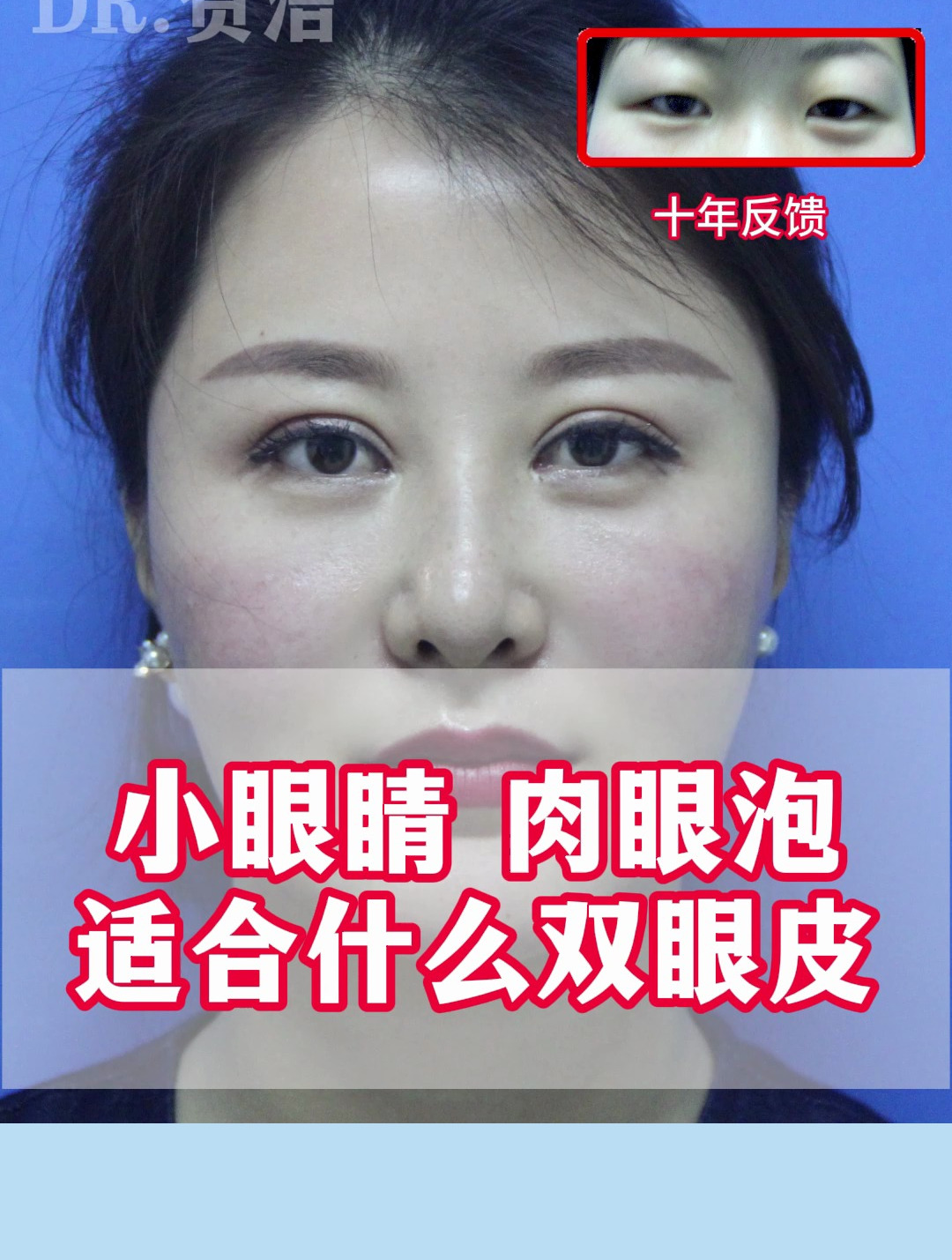 双眼皮调整完十年了,来看看小眼睛 肉眼泡适合什么双眼皮