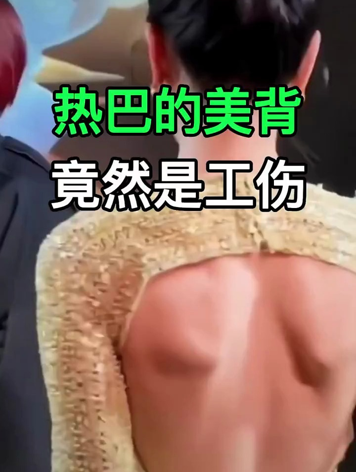 又有媒体吹捧“蝴蝶骨”,迪丽热巴背上的骨头翘起,其实是一种病