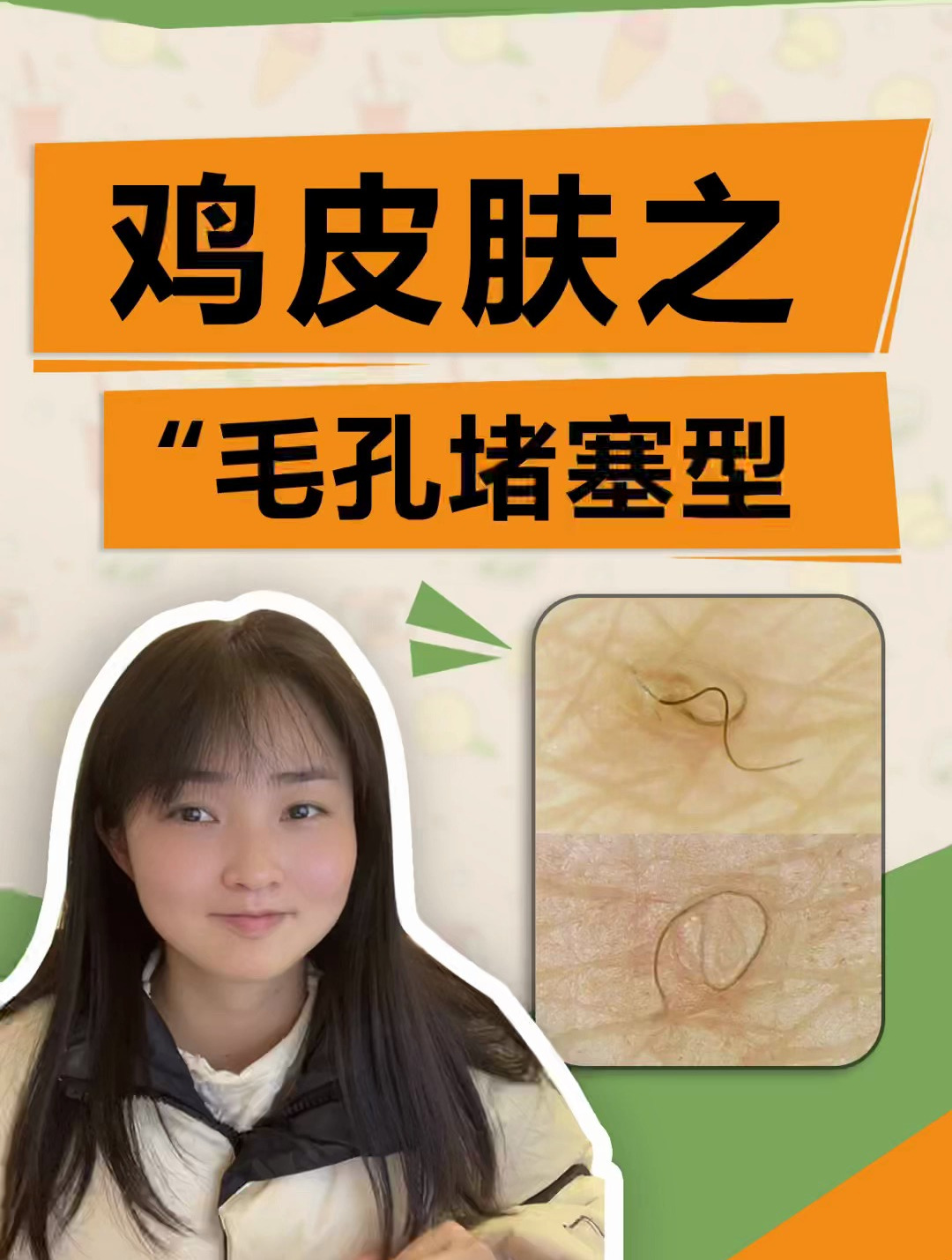 鸡皮肤之毛孔堵塞型