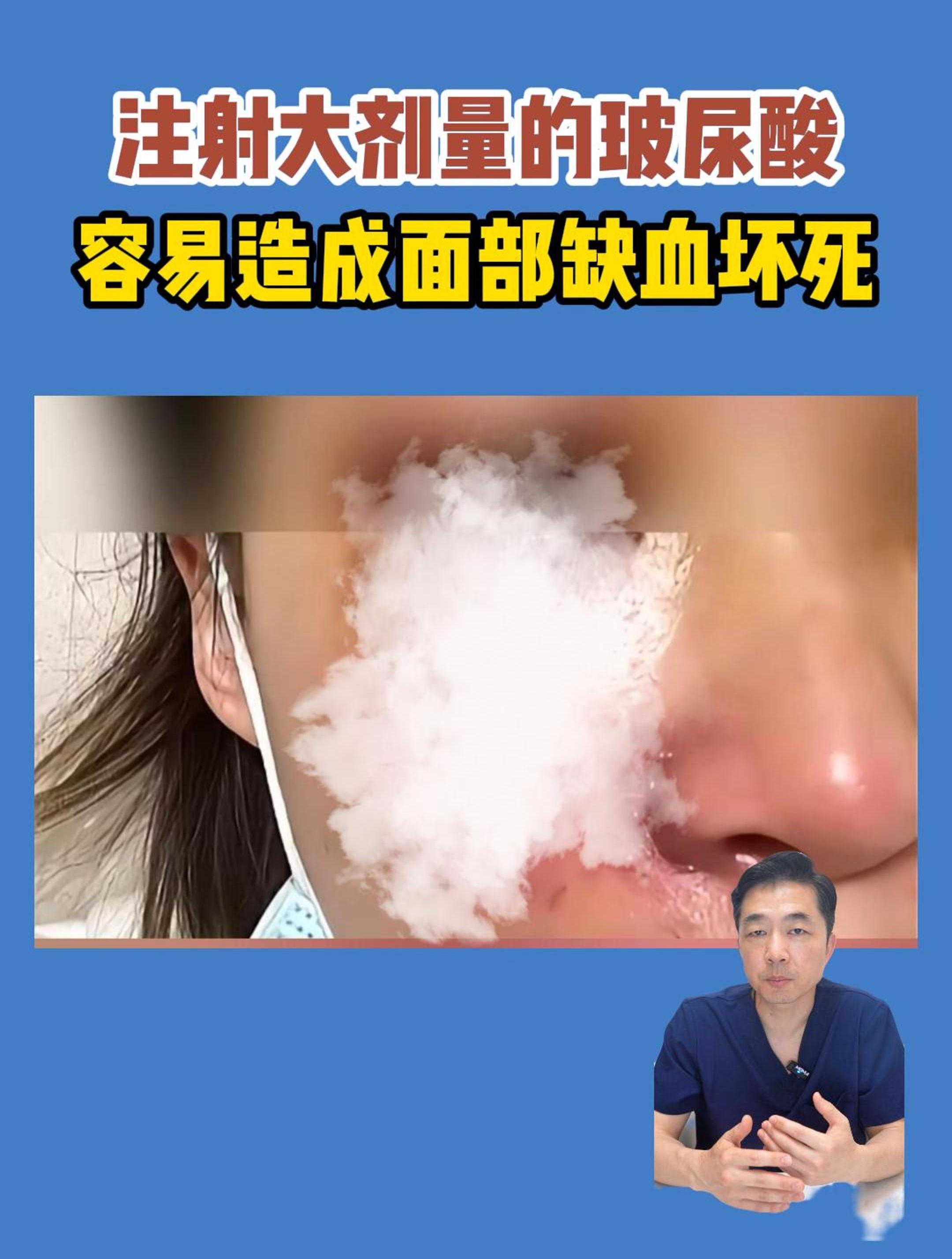 大剂量注射玻尿酸,容易造成缺血坏死