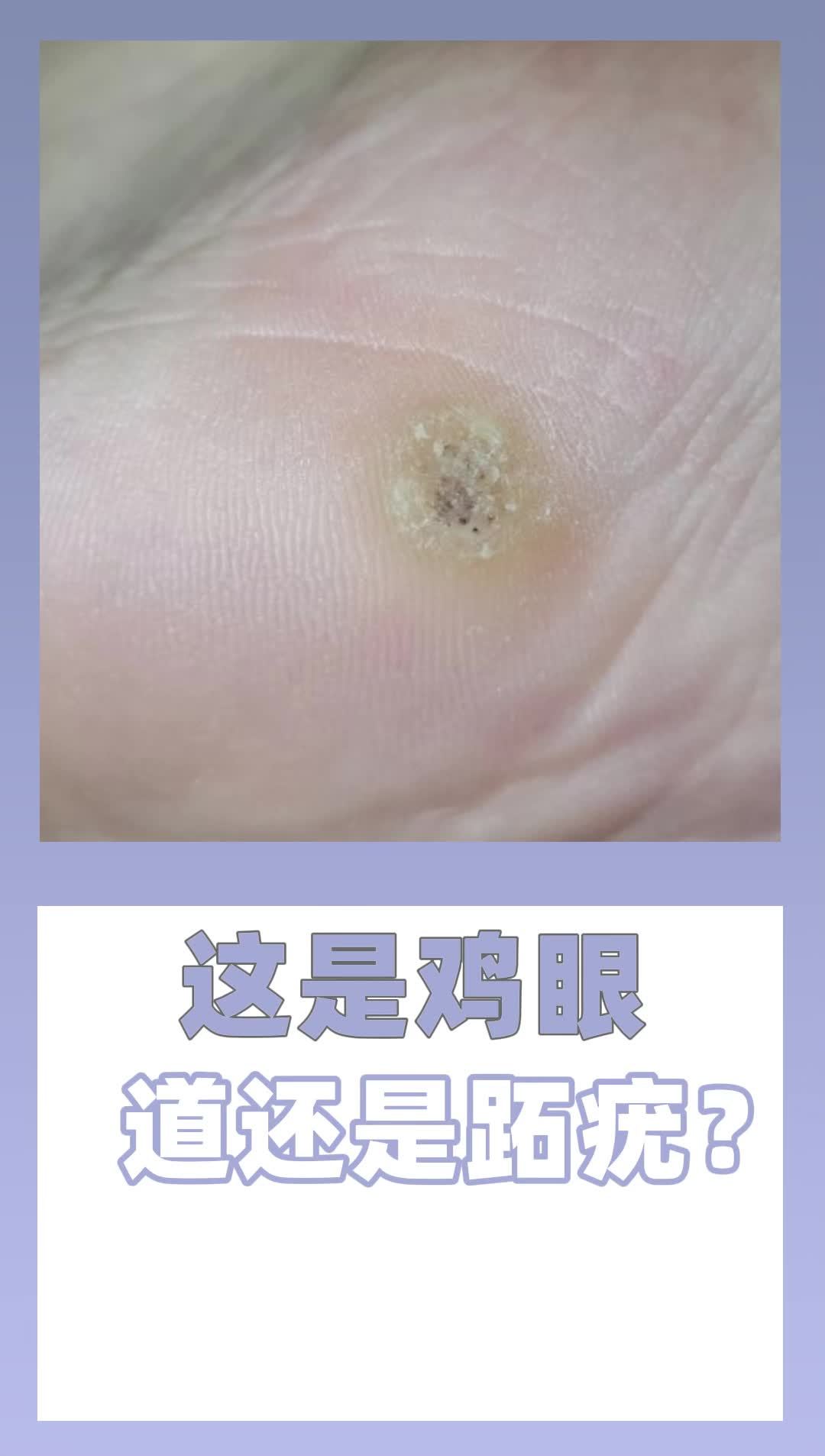 3.7 这是鸡眼 还是跖疣?(1)