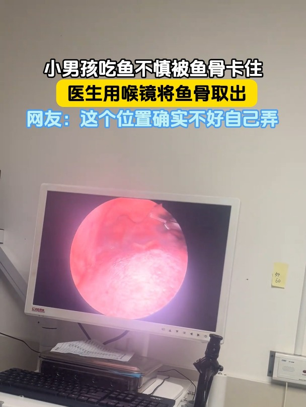 小男孩吃鱼不慎被鱼骨卡住,医生用喉镜将鱼骨取出