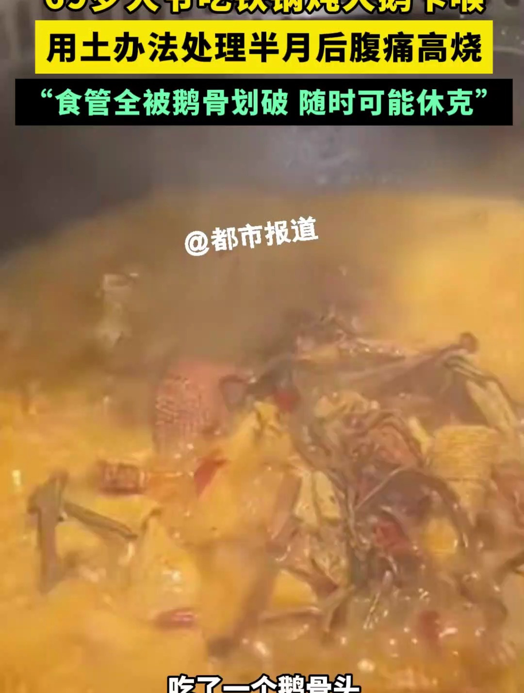 危险!大爷吃铁锅炖大鹅卡喉,食管被鹅骨划破随时可能休克