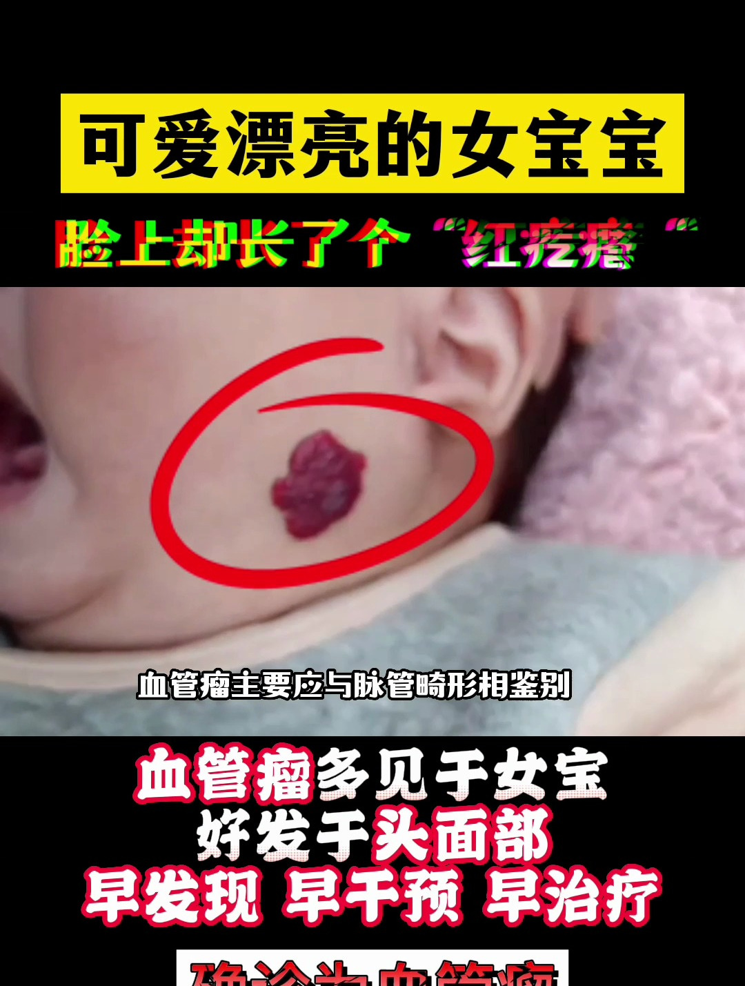 漂亮女宝宝,脸上长了个红疙瘩?血管瘤 介入治疗