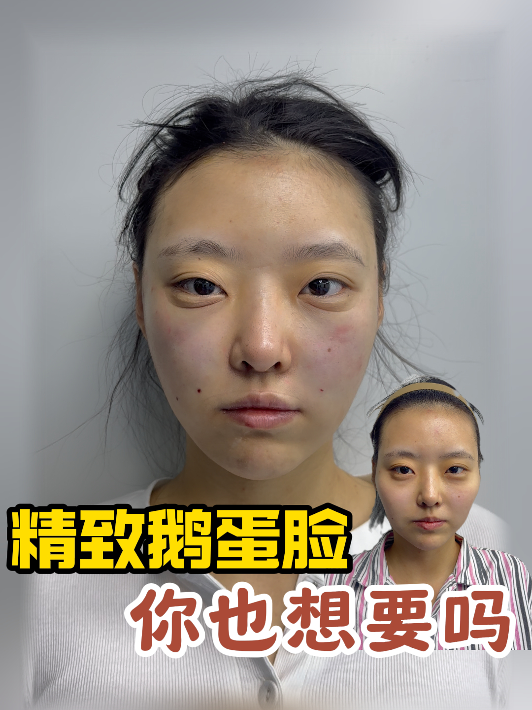 精致鹅蛋脸,你也想要么?