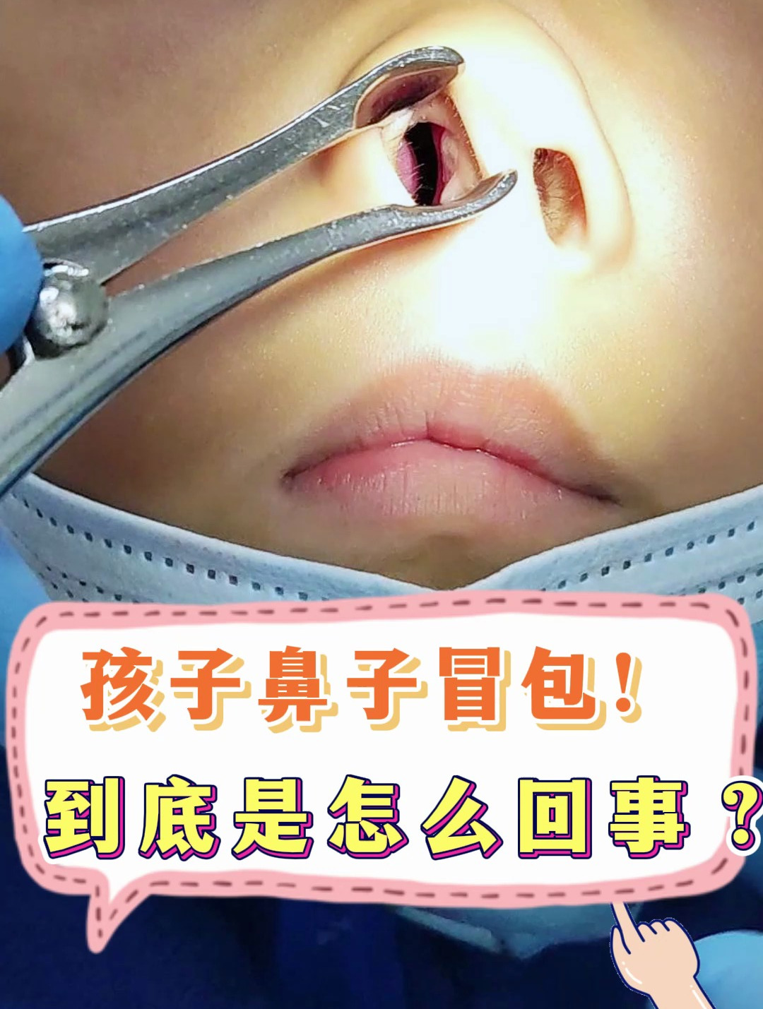 孩子鼻孔里的肉球,到底是啥东西呢?