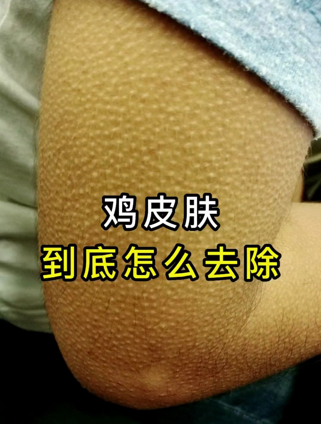 你知道什么是鸡皮肤吗?鸡皮肤