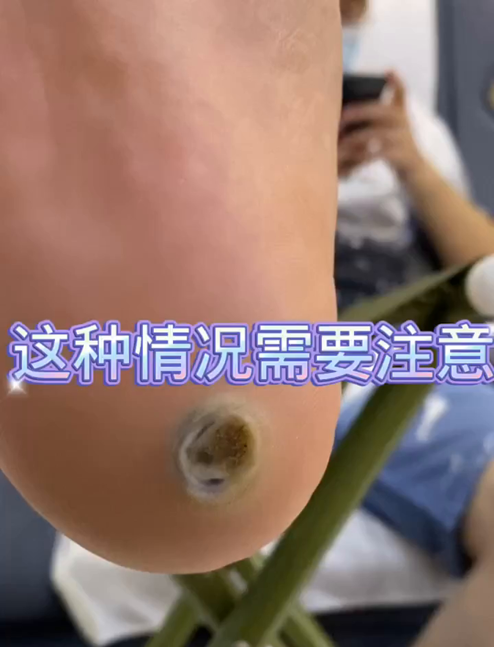 别小看脚上这硬块！可能是鸡眼、嵌甲或跖疣