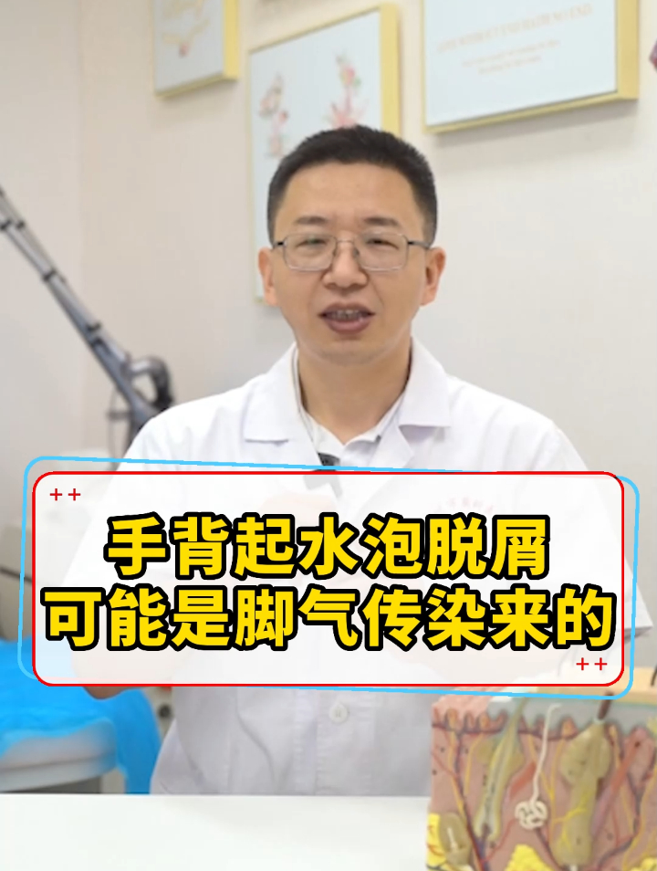 手背起水泡还脱屑,这可能是脚气真菌传染引起的手癣,怎么办呢?