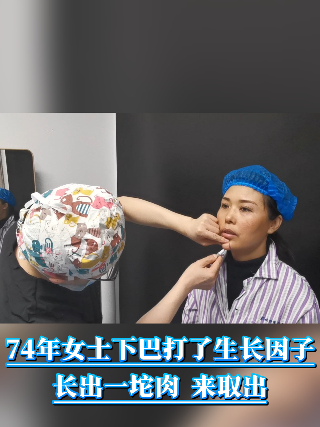 整形修复故事:74年女士下巴打了生长因子,长出一坨肉,来取出