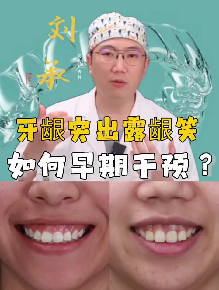 牙龈突出露龈笑如何早期干预?