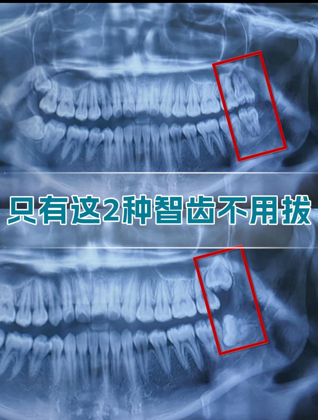 什么样的智齿可以不用拔?