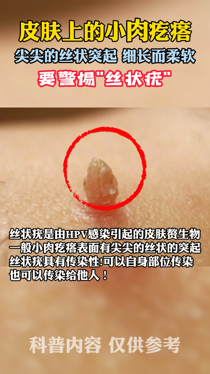 皮肤上的小肉疙瘩,如果是这种尖尖的要引起注意了!