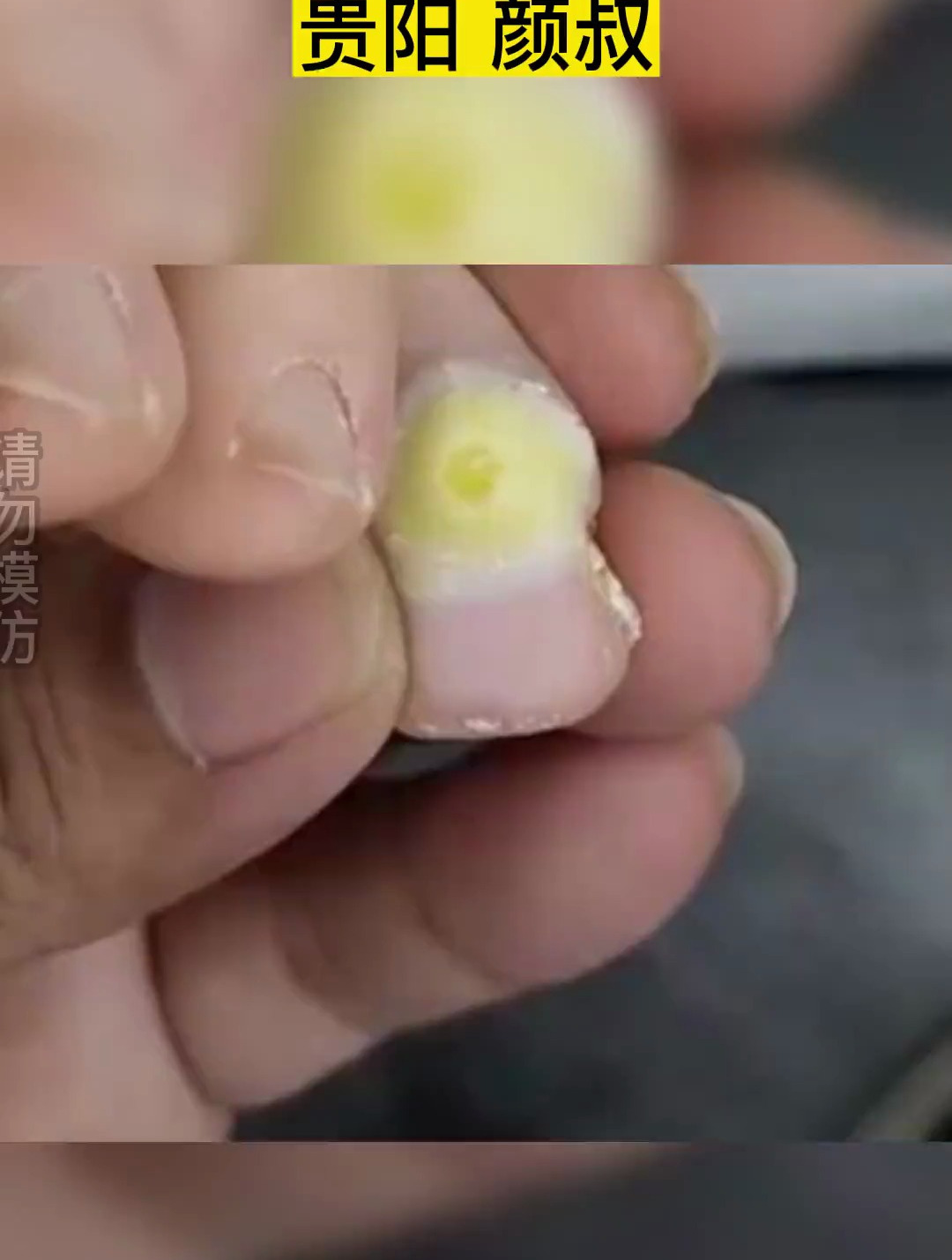 解压视频 鸡眼 修脚 贵阳 极度舒适