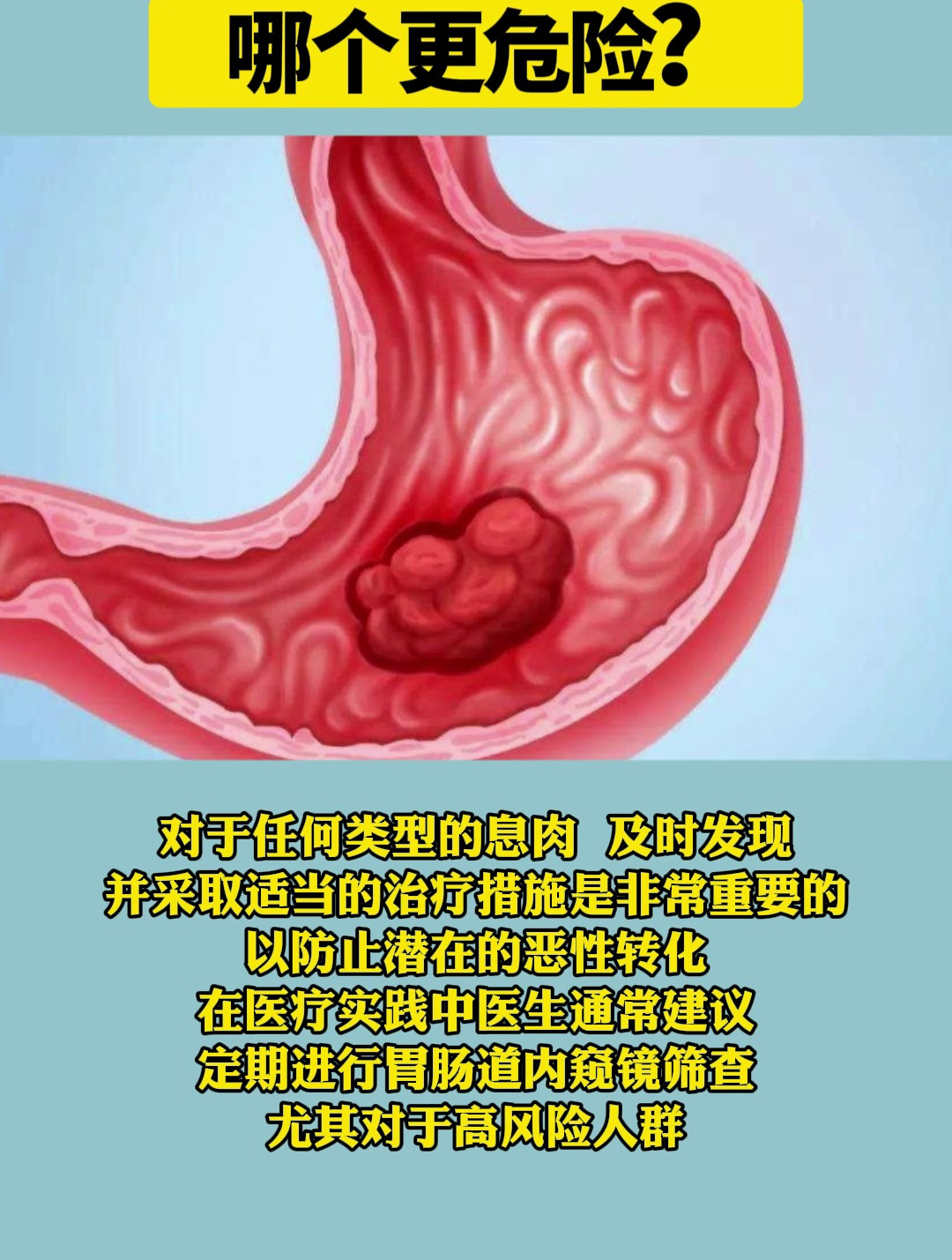 胃息肉与肠息肉,哪个更危险?