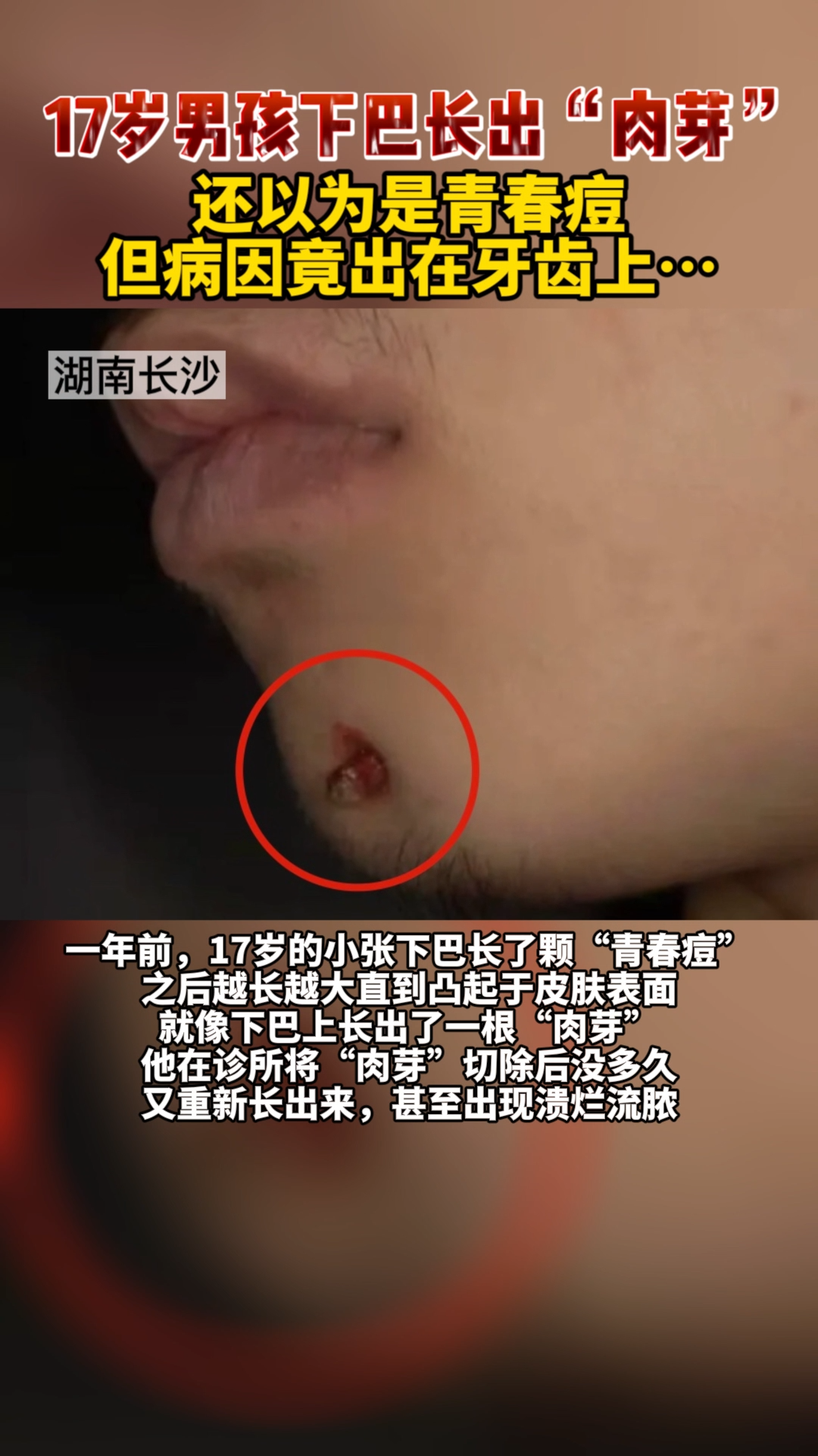长沙17岁男孩下巴长出了“肉芽”以为是 痘痘,但病因竟出在 牙齿上……