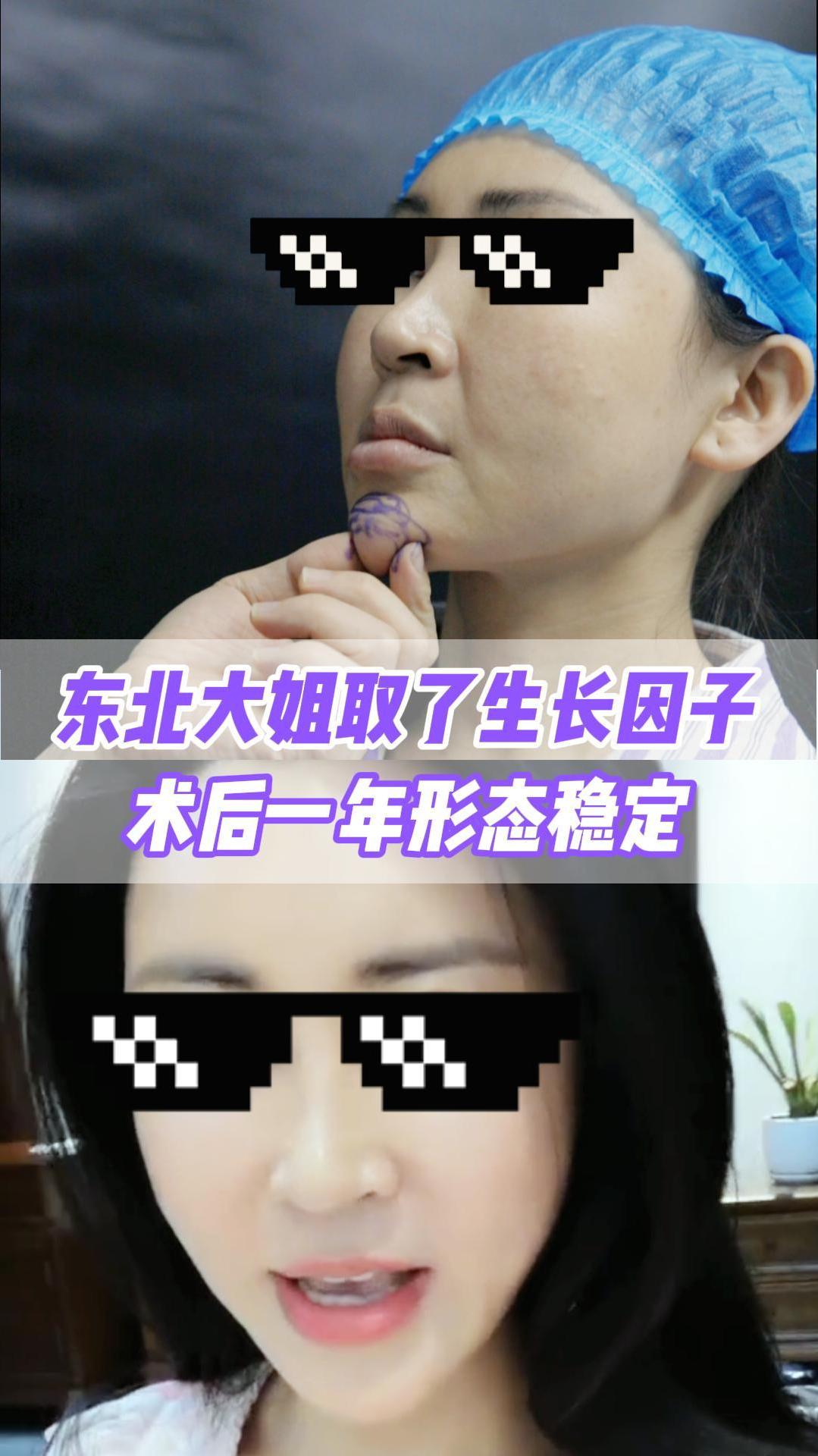 东北大姐取了下巴生长因子,术后一年形态稳定