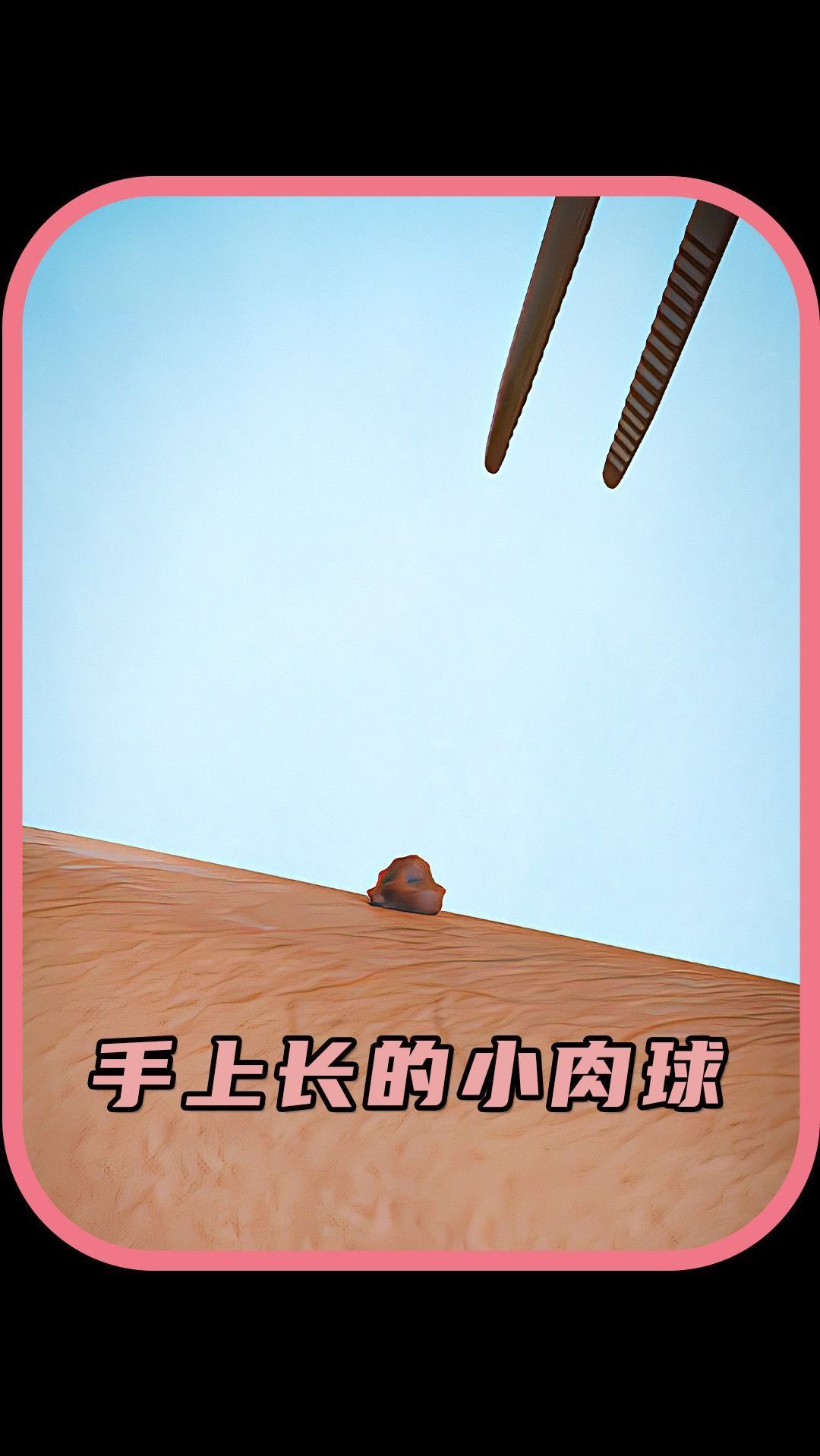 手上长的小肉球可以自己摘掉吗?