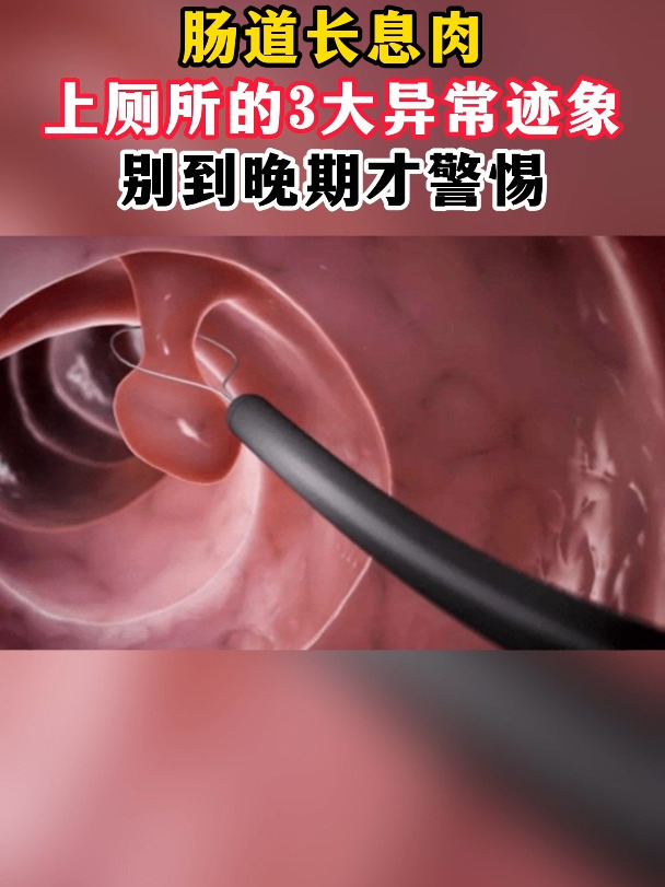 肠道长息肉,上厕所的3大异常迹象,别到晚期才警惕