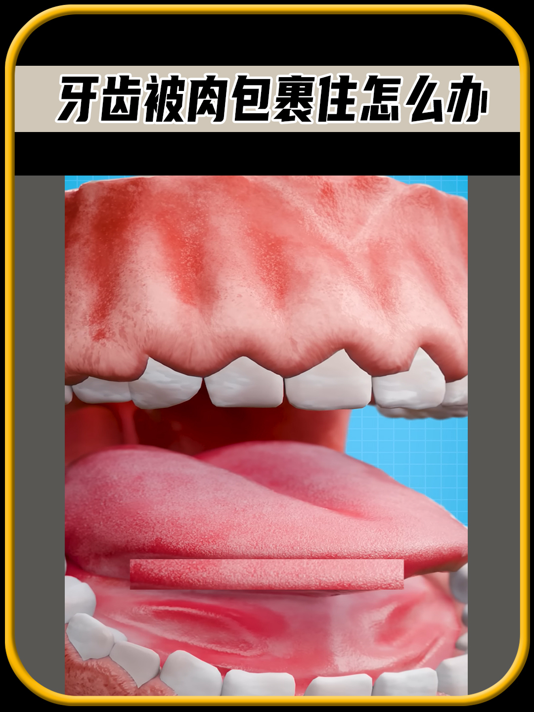 你知道牙齿被肉包裹住该怎么办吗?值得一看