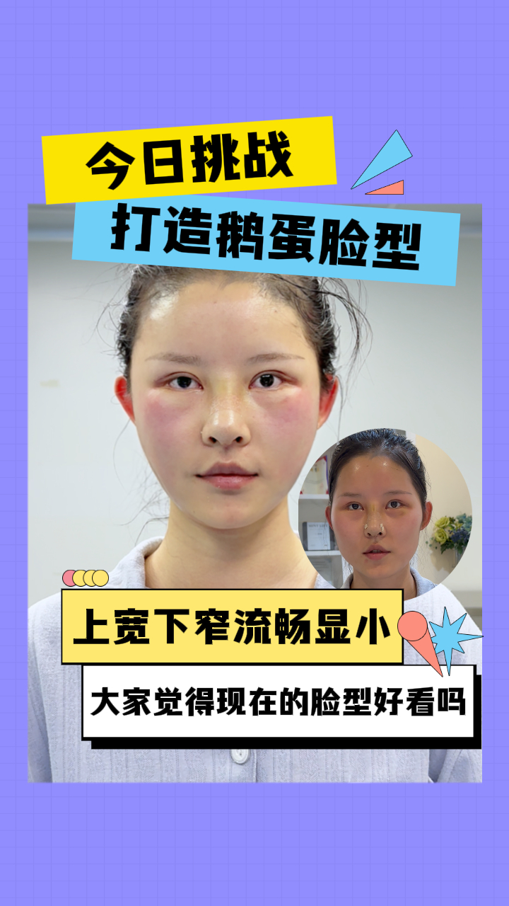 找姚院改善脸型,从大小脸—鹅蛋脸,大家觉得现在的脸型好看吗?