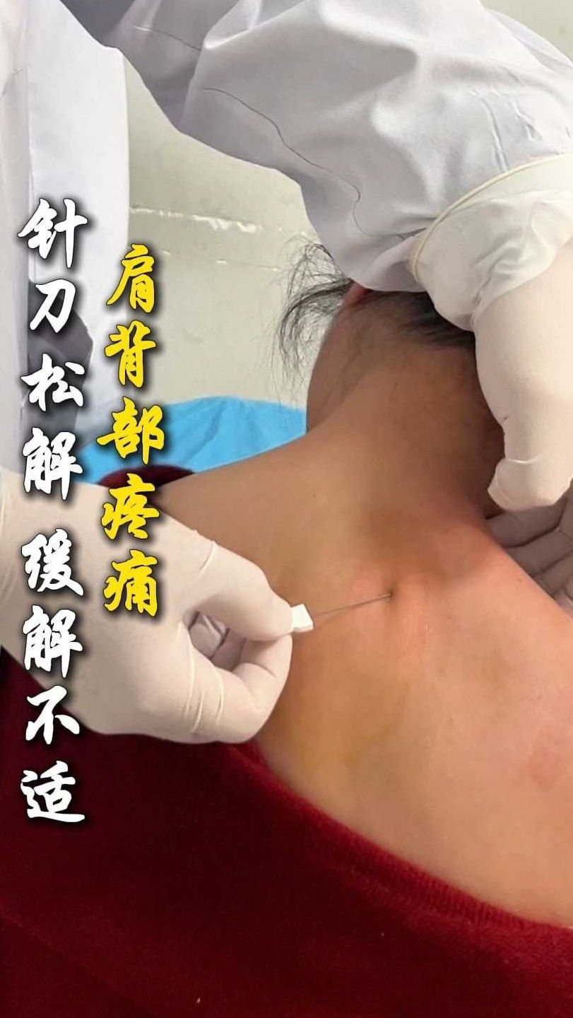 肩背部疼痛针刀松解 缓解不适