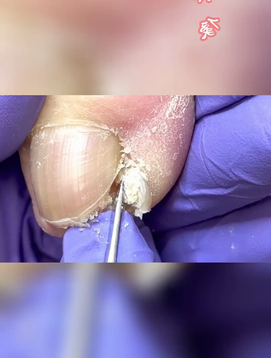 修剪拔甲后又重新长进肉里的趾甲,趾甲又厚又硬的。修指甲