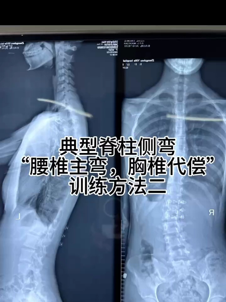 矫正脊柱侧弯,公认的保守治疗安全有效的方法:“美人鱼坐姿”