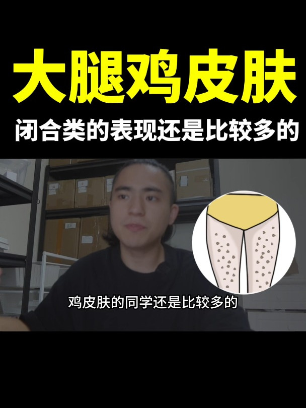 大腿上,闭合型鸡皮肤的同学,还是比较多的