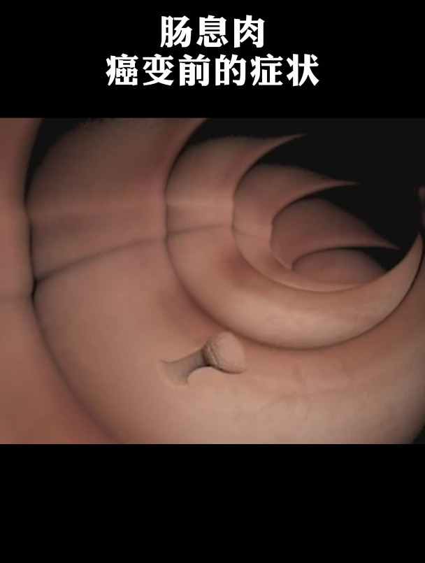 肠息肉癌变前的症状!