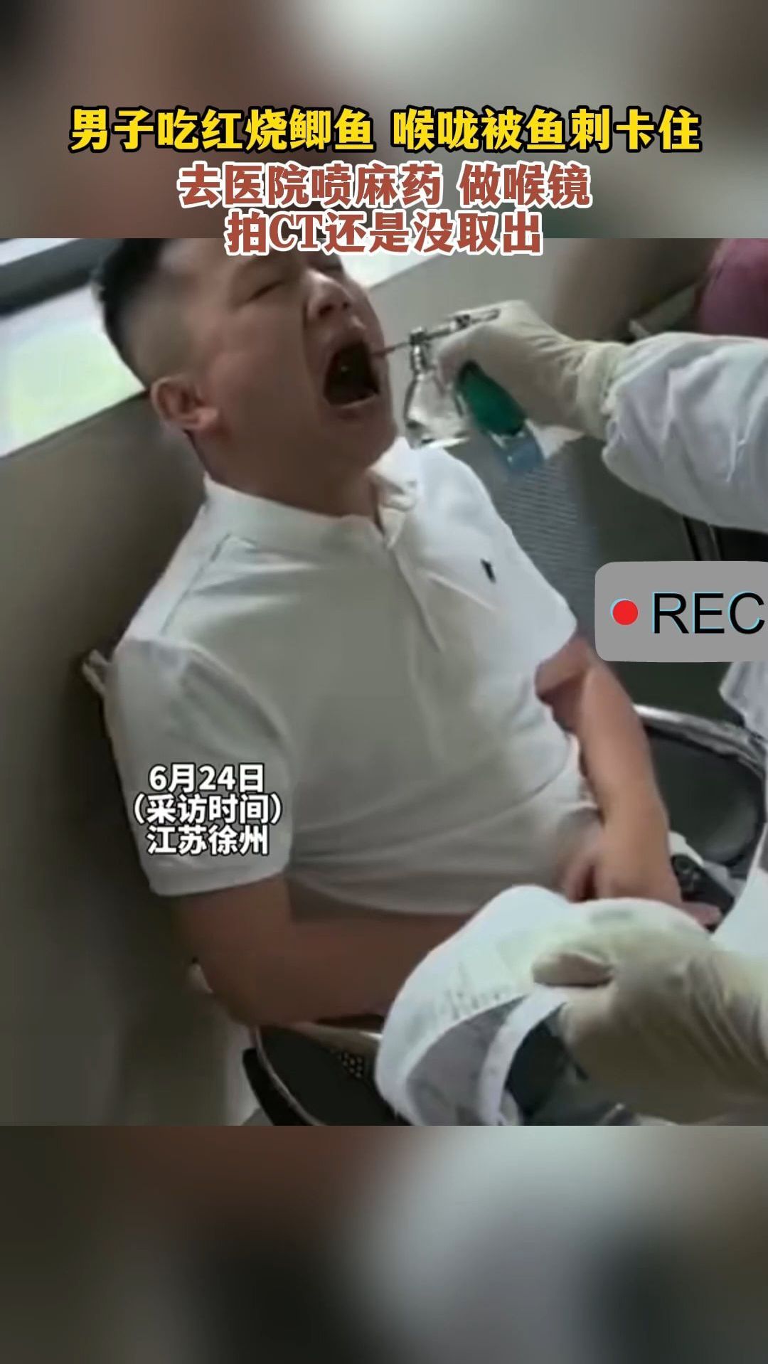 男子喉咙被鱼刺卡住,去医院喷麻药,做喉镜,拍CT还是没取出