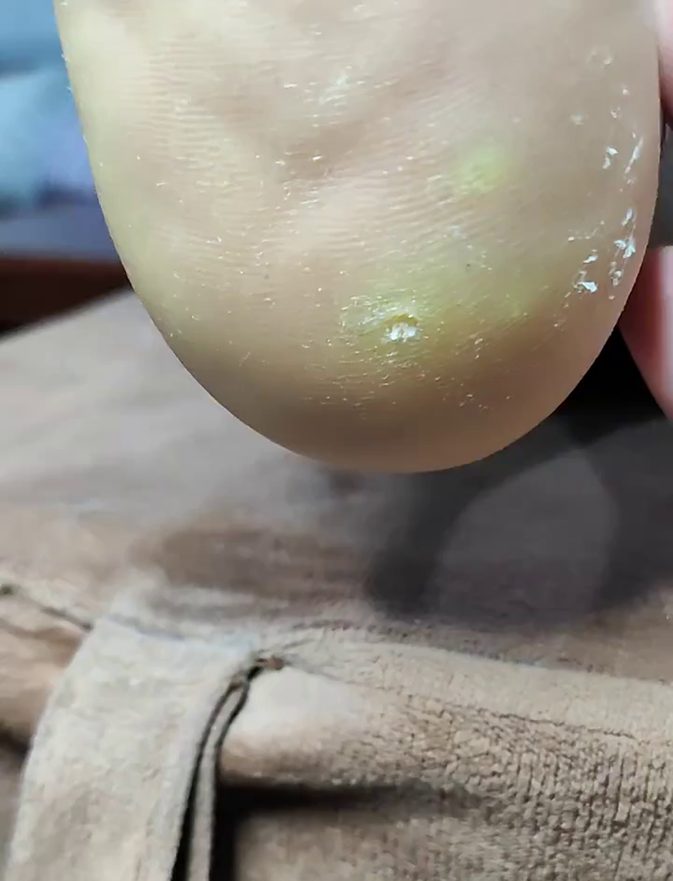 脚底长硬块别大意，可能是鸡眼或老茧